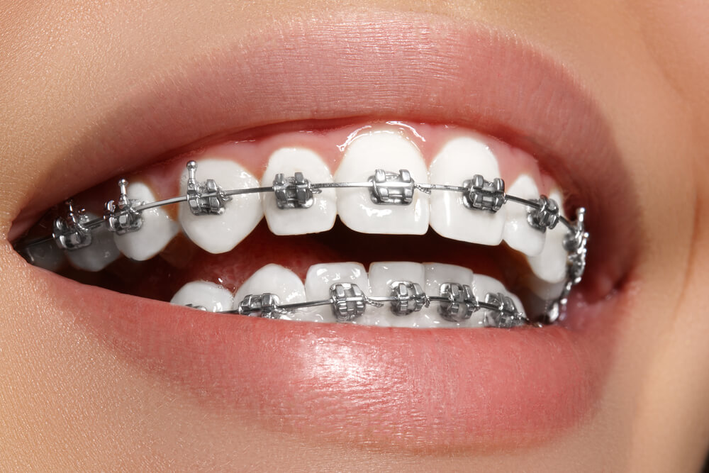¿Los adultos pueden usar correctores dentales?